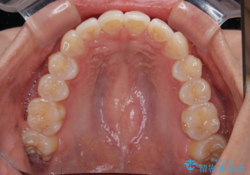 前歯のデコボコを治したい　インビザライン矯正の治療後
