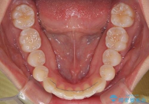 前歯のデコボコを治したい　インビザライン矯正の治療後