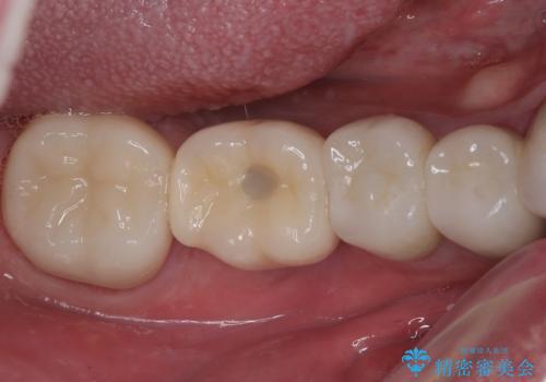 破折した奥歯 1DAYインプラントで短期間治療の症例 治療後