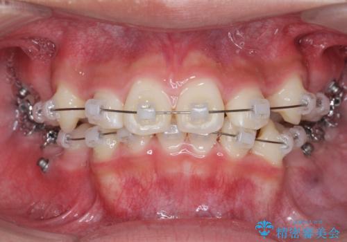 がちゃがちゃした前歯をきれいにしたいの治療中