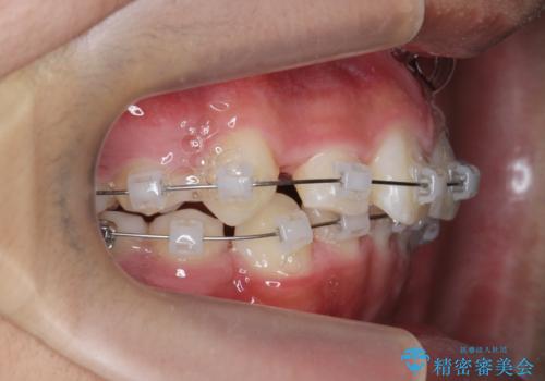 がちゃがちゃした前歯をきれいにしたいの治療中