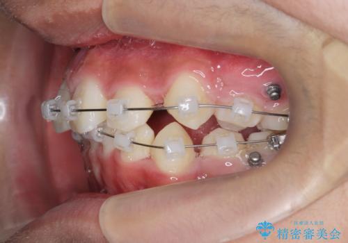 がちゃがちゃした前歯をきれいにしたいの治療中