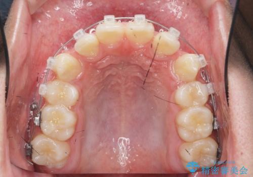 がちゃがちゃした前歯をきれいにしたいの治療中