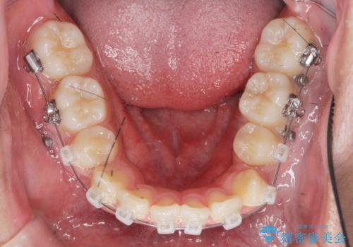 がちゃがちゃした前歯をきれいにしたいの治療中