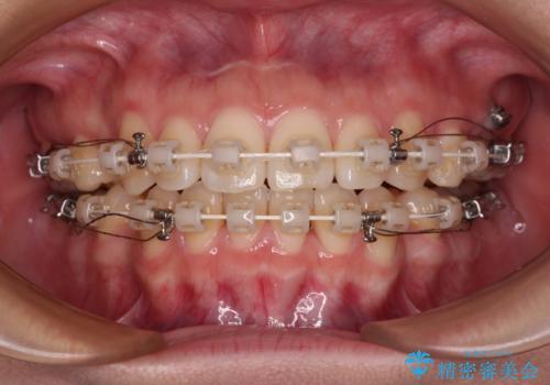 横顔の印象を変えたい ワイヤー装置での抜歯矯正の治療中