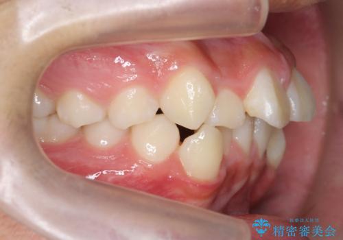 がちゃがちゃした前歯をきれいにしたいの治療前