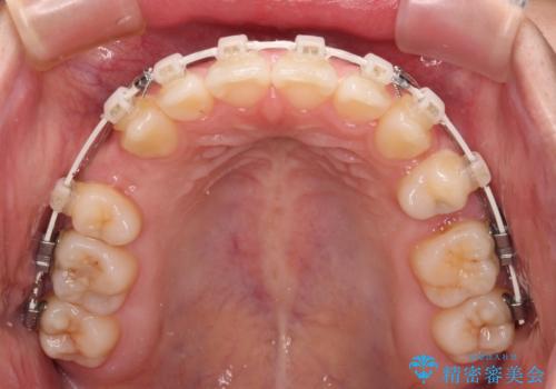 横顔の印象を変えたい ワイヤー装置での抜歯矯正の治療中
