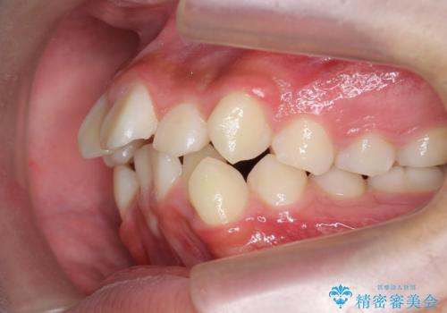 がちゃがちゃした前歯をきれいにしたいの治療前