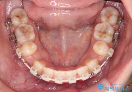 横顔の印象を変えたい ワイヤー装置での抜歯矯正の治療中
