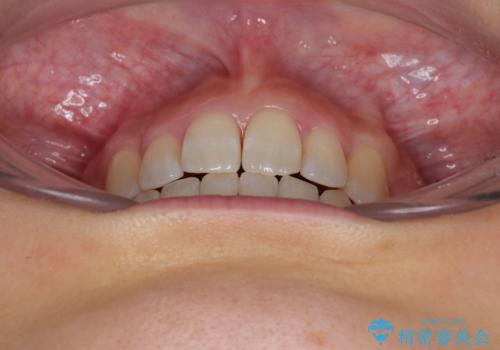 八重歯を改善 ワイヤー装置での抜歯矯正の治療後