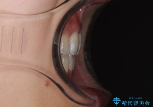 八重歯を改善 ワイヤー装置での抜歯矯正の治療後