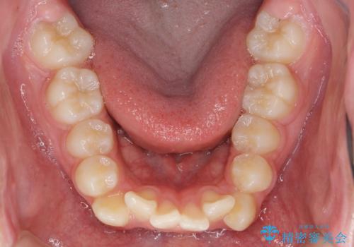 がちゃがちゃした前歯をきれいにしたいの治療前