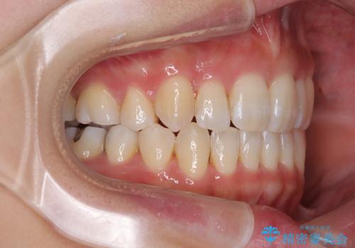 八重歯を改善 ワイヤー装置での抜歯矯正の治療後
