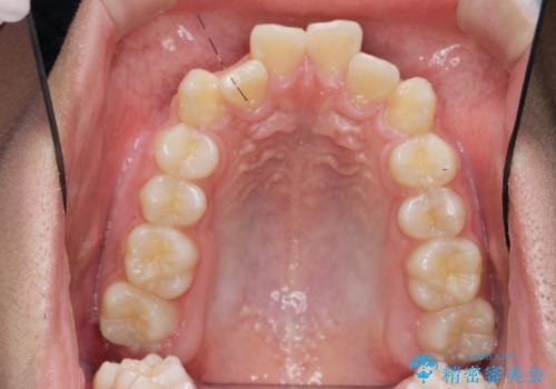 がちゃがちゃした前歯をきれいにしたいの治療前