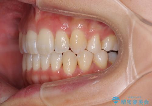 八重歯を改善 ワイヤー装置での抜歯矯正の治療後