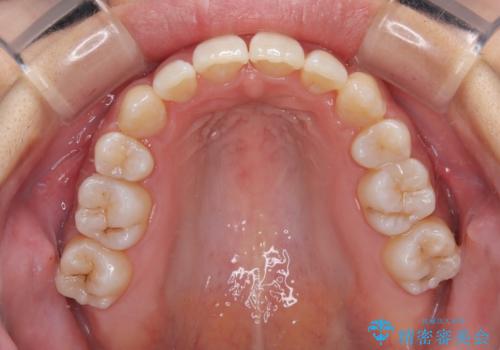 八重歯を改善 ワイヤー装置での抜歯矯正の治療後