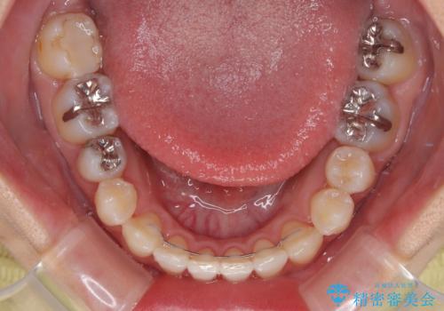 八重歯を改善 ワイヤー装置での抜歯矯正の治療後
