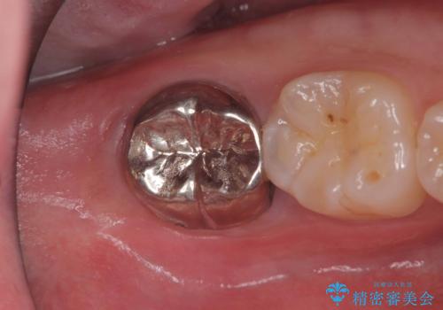 銀歯を白くしたい|オールセラミッククラウンの症例 治療前