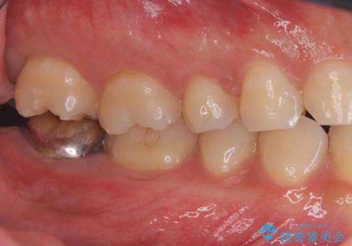 銀歯を白くしたい|オールセラミッククラウンの治療前