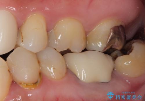 下顎大臼歯の再根管治療とオールセラミッククラウンによる補綴治療の治療後