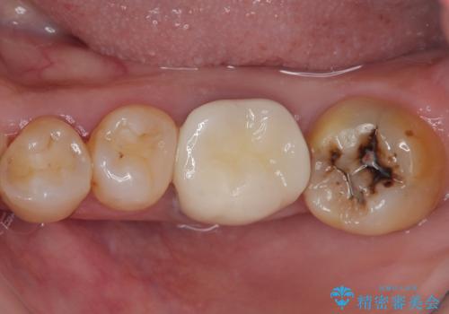 下顎大臼歯の再根管治療とオールセラミッククラウンによる補綴治療の症例 治療後