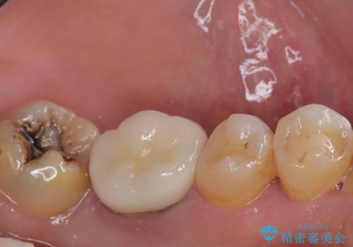 下顎大臼歯の再根管治療とオールセラミッククラウンによる補綴治療の治療後