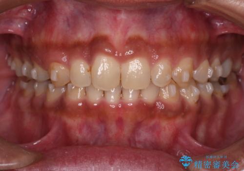 【モニター】インビザライン 前歯の捻れを治したいの治療中