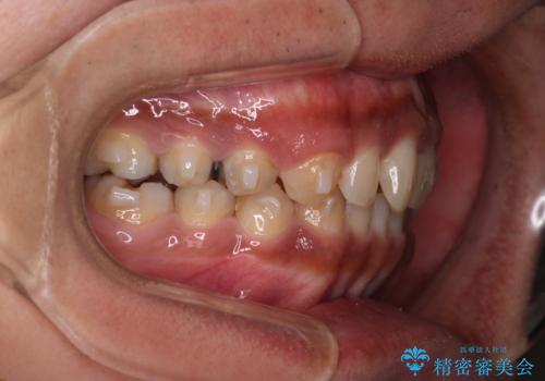 【モニター】インビザライン 前歯の捻れを治したいの治療中