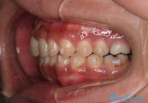 【モニター】インビザライン 前歯の捻れを治したいの治療中