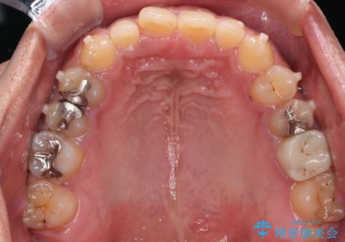 【モニター】インビザライン 前歯の捻れを治したいの治療中