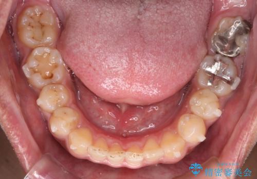 【モニター】インビザライン 前歯の捻れを治したいの治療中