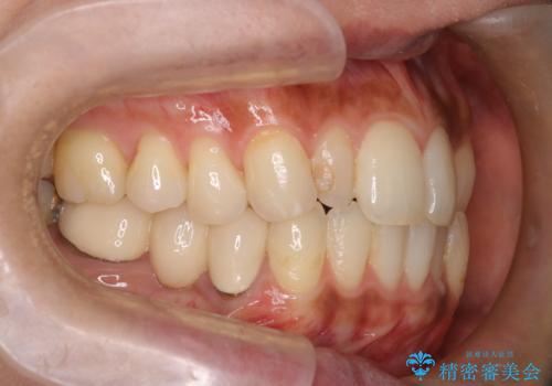矮小歯を伴う叢生を審美的に改善|インビザライン矯正+セラミッククラウン修復の治療前