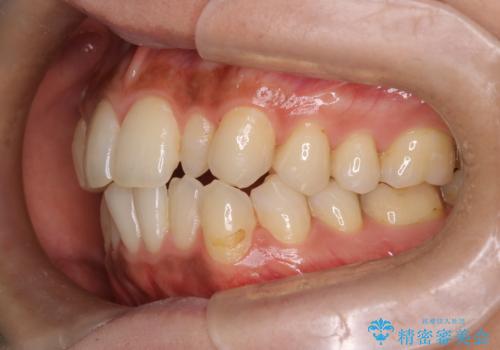 矮小歯を伴う叢生を審美的に改善|インビザライン矯正+セラミッククラウン修復の治療前