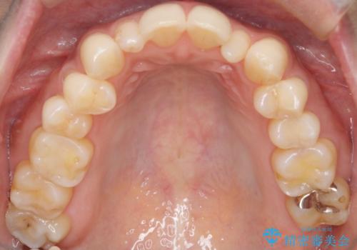 矮小歯を伴う叢生を審美的に改善|インビザライン矯正+セラミッククラウン修復の治療前