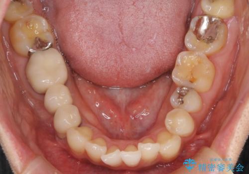 矮小歯を伴う叢生を審美的に改善|インビザライン矯正+セラミッククラウン修復の治療前