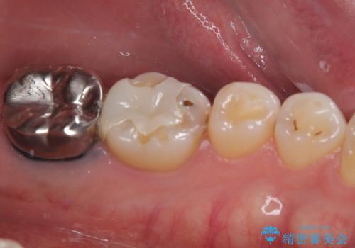 ものが噛めないほどの激痛 根管治療とセラミックのむし歯治療の治療前