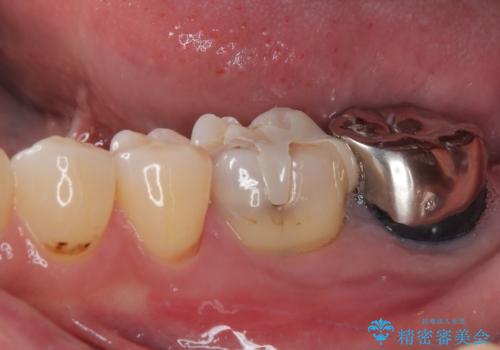 ものが噛めないほどの激痛 根管治療とセラミックのむし歯治療の治療前