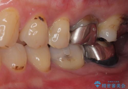 ものが噛めないほどの激痛 根管治療とセラミックのむし歯治療の治療前