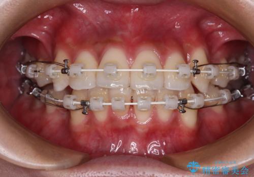【モニター】デコボコ前歯をワイヤー装置での抜歯矯正で改善の治療中