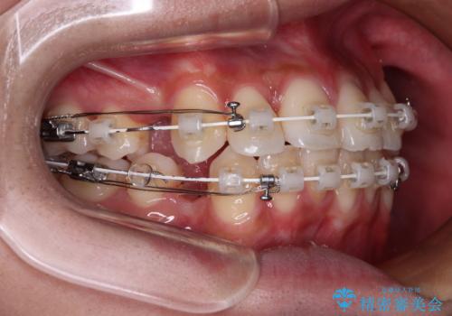【モニター】デコボコ前歯をワイヤー装置での抜歯矯正で改善の治療中