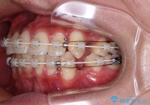 【モニター】デコボコ前歯をワイヤー装置での抜歯矯正で改善の治療中