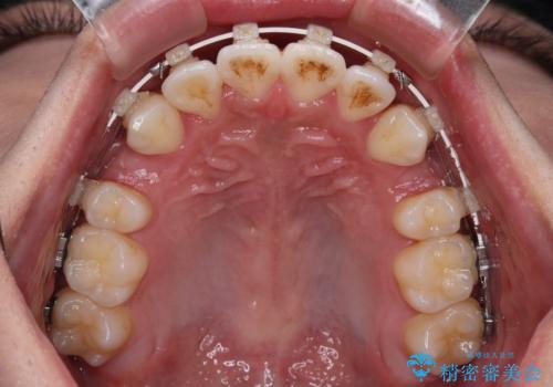 【モニター】デコボコ前歯をワイヤー装置での抜歯矯正で改善の治療中