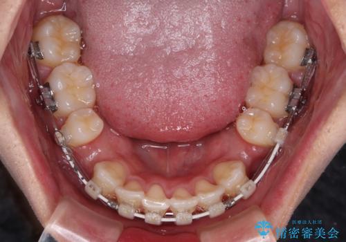 【モニター】デコボコ前歯をワイヤー装置での抜歯矯正で改善の治療中