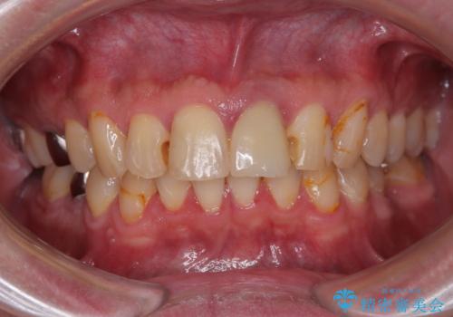 前歯の見た目を良くしたい オールセラミッククラウンの治療前