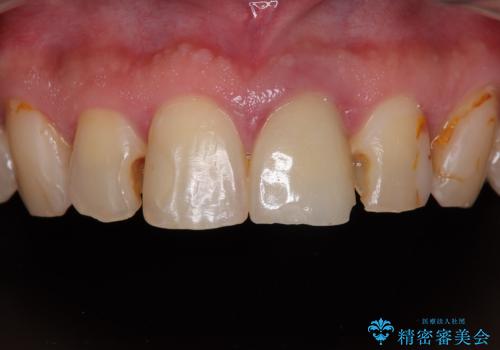 前歯の見た目を良くしたい オールセラミッククラウンの症例 治療前