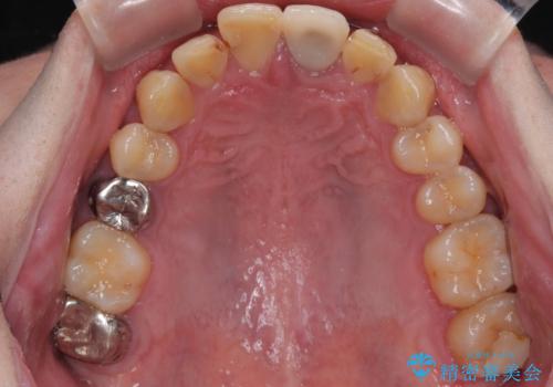 前歯の見た目を良くしたい オールセラミッククラウンの治療前
