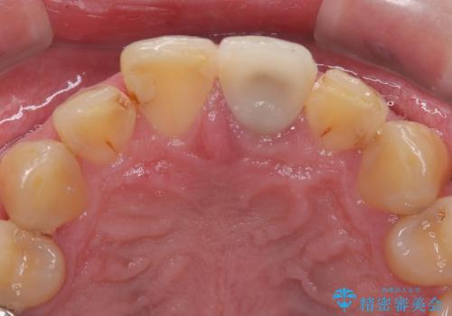 前歯の見た目を良くしたい　オールセラミッククラウンの治療前