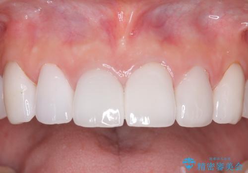 メンテナンスで10年後のセラミックの症例 治療後