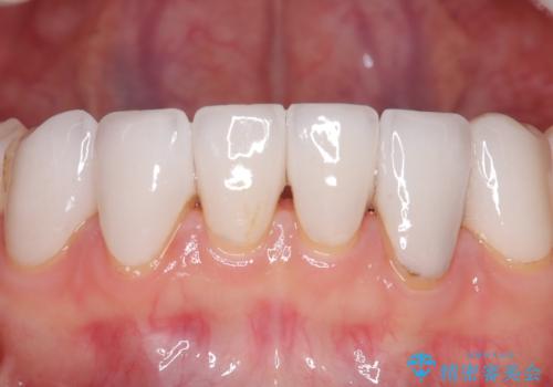 メンテナンスで10年後のセラミックの治療後