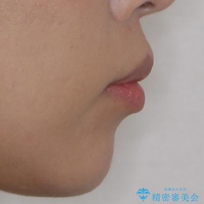 出っ歯と奥歯のむし歯 ワイヤー装置での抜歯矯正とセラミック治療の治療前(顔貌)